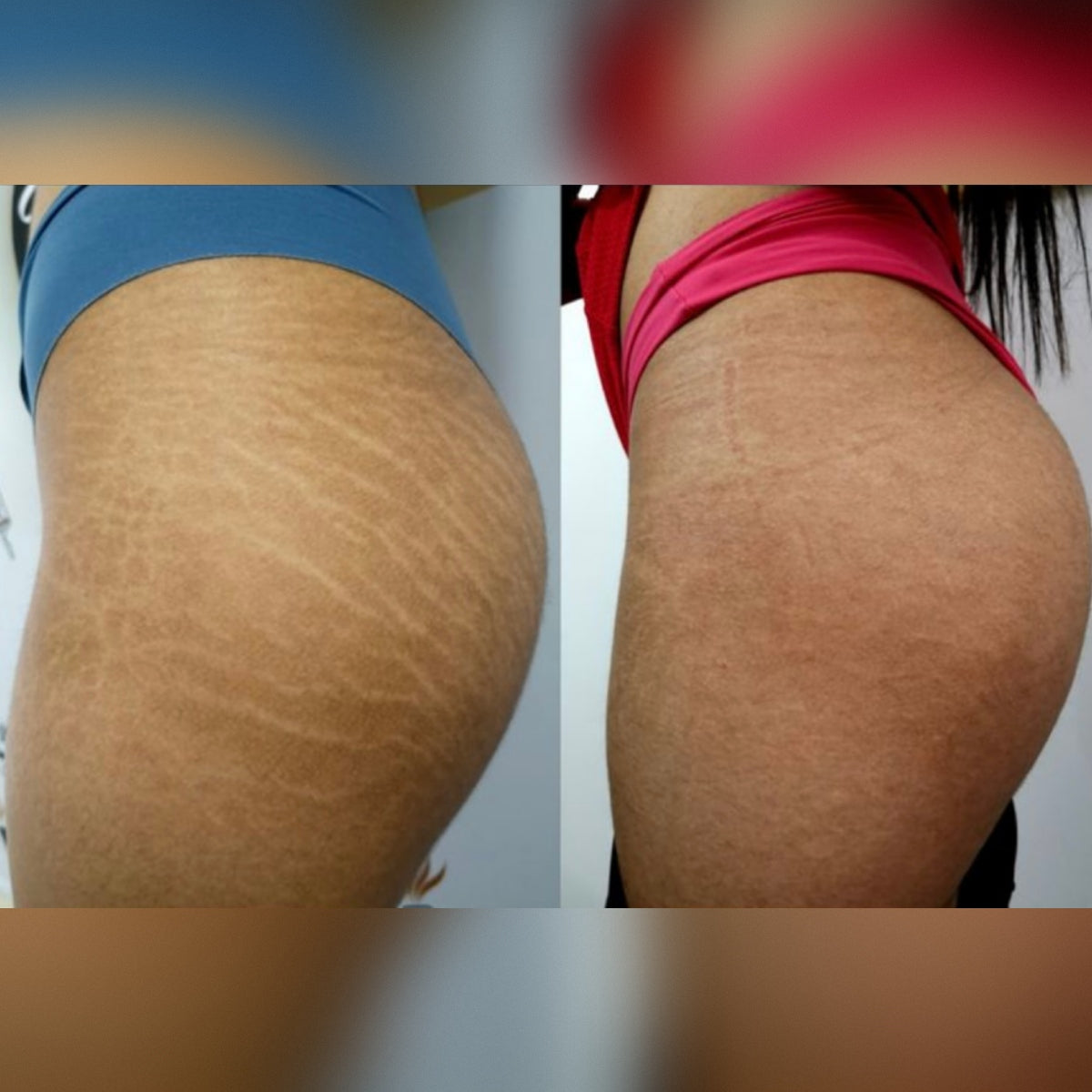 Crema Antistretch | Essenza™