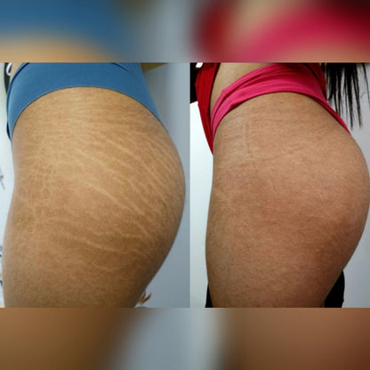 Crema Antistretch | Essenza™