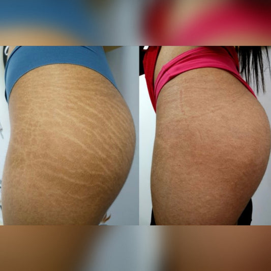 Crema Antistretch | Essenza™